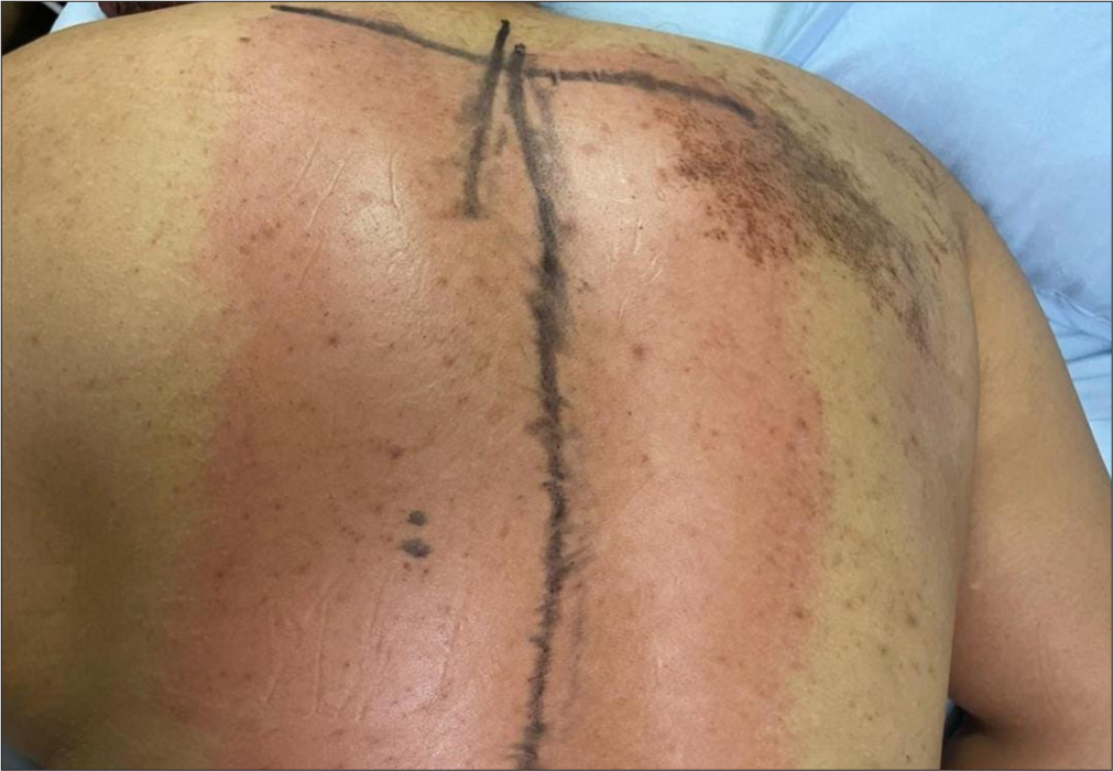 Case 2 - Immediately post-application, illustrating the immediate response to the therapy.