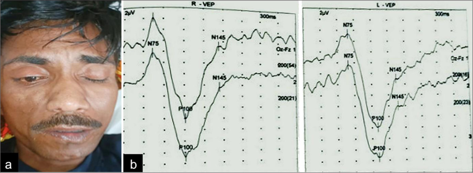 (a) Incomplete closure of right eye with flattening of the right nasolabial fold; (b): Visual evoked potentials showing prolonged P-100 latencies in both eyes (114 milliseconds in the right eye and 126 milliseconds in the left eye).