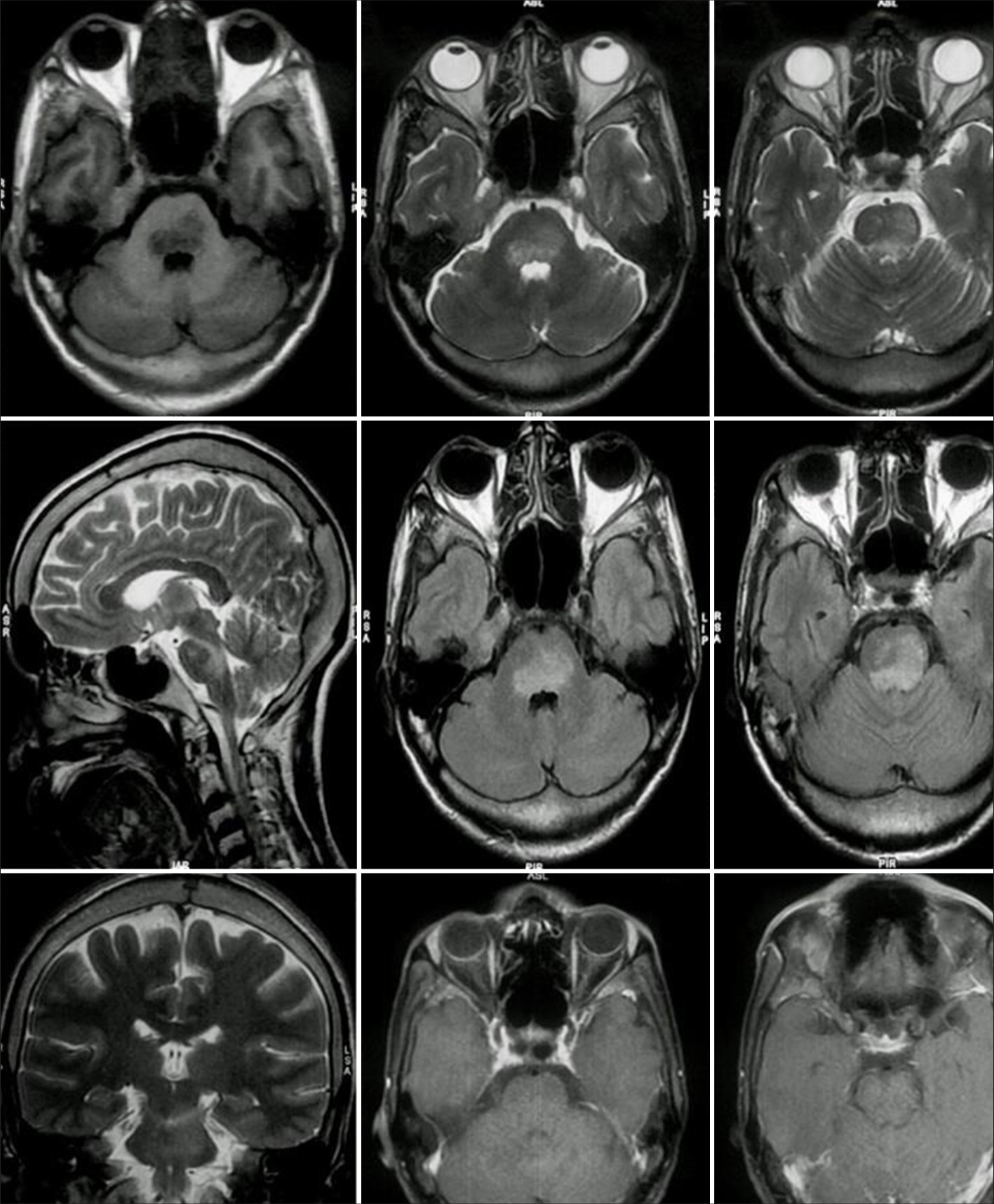 Magnetic resonance imaging of the brain showing fluffy non-enhancing hyperintensities involving the pontine tegmentum.