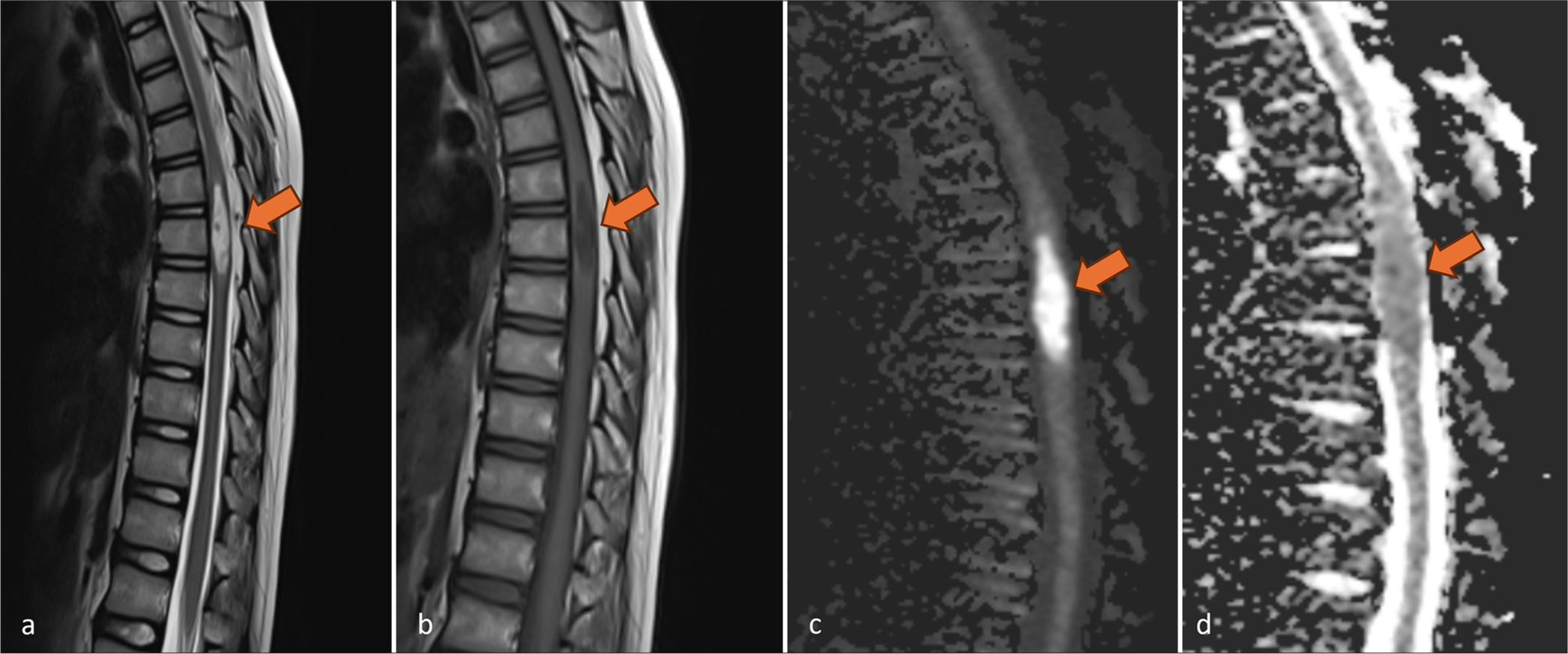 Sagittal non-enhanced magnetic resonance images of dorsal spine reveal a well-defined elliptical lesion (arrows) in dorsal cord, focally expanding the cord. It shows (a) hyperintense signal on T2-weighted images and (b) hypointense signal on T1-weighted images. (c) On diffusion-weighted imaging and (d) corresponding apparent diffusion coefficient map, the lesion shows diffusion restriction.