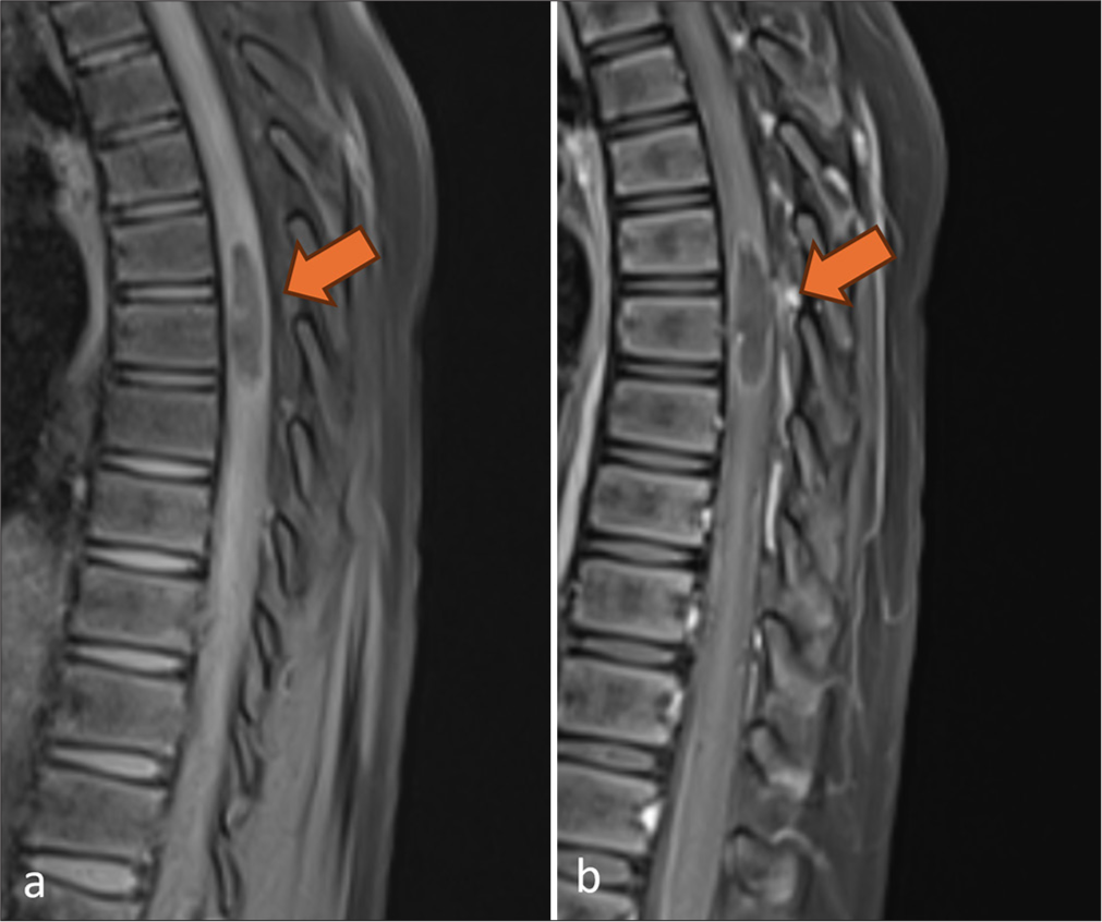 Sagittal (a) pre-contrast and (b) post-contrast T1 fat-suppressed magnetic resonance images show mild peripheral rim enhancement (arrows) of the lesion.