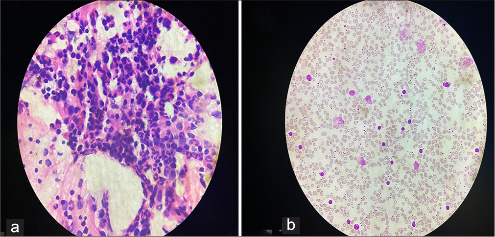 (a) Bone marrow biopsy (hematoxylin and eosin, 100x) showing increased lymphocytes. (b) Peripheral smear (hematoxylin and eosin, 10x) showing lymphocytes with smudge cells.