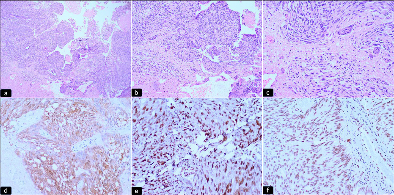 (a-c) Microphotograph sections showing a hypercellular glial tumor with prominent endothelial proliferation (hematoxylin and eosin 4X, 10X, 20X, respectively). (d-f) Microphotograph sections showing immunohistochemical expression of (d) IDH (e) p53 and (f) ATRX. The tumor cells show immunopositivity for IDH and p53 and ATRX expression is retained, diagnostic of IDH-mutant Grade 4 astrocytoma (IPOX) (hematoxylin and eosin 20X).
