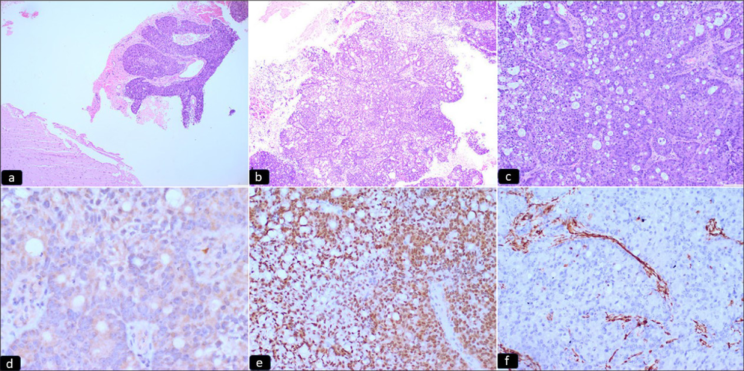 (a-c) Microphotograph sections showing a non-glial tumor with epithelial differentiation, arranged in glandular pattern and solid sheets. Normal glial tissue is noted lying adjacent (hematoxylin and eosin 4X, 10X, 20X, respectively). (d-f) Microphotograph sections showing immunohistochemical expression of (d) CK20, (e) CDX2, and (f) Vimentin. The tumor cells show immunopositivity for CK20 and CDX2, indicative of gastrointestinal origin (IPOX) (hematoxylin and eosin 20X).