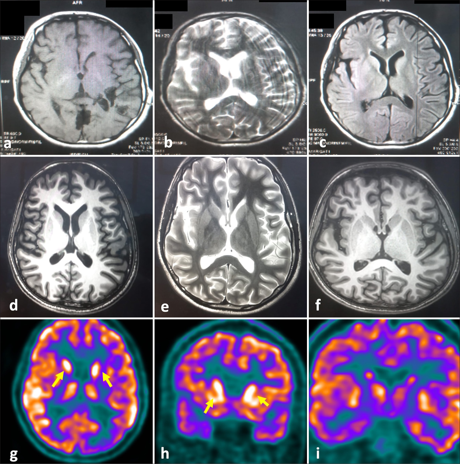 The brain magnetic resonance imaging (MRI) images and 18FDG-PET images of the patient. (a-c) showing brain MRI images of the patient at the time of initial hospitalization six months before the presentation to us. (a) T1 axial, (b) T2 axial, and (c) T2 FLAIR axial images of brain show no abnormality. (d-T1 axial, e-T2-axial) showing brain MRI images at the time of admission depicting cerebral atrophy compared to the previous imaging. (f) depicts T1 post-contrast axial section of brain showing no evidence of contrast enhancement. (g-i) F-18 FDG PET shows hypermetabolism in both basal ganglia (yellow arrows) and mesial temporal regions with occipital hypometabolism suggestive of autoimmune encephalitis.