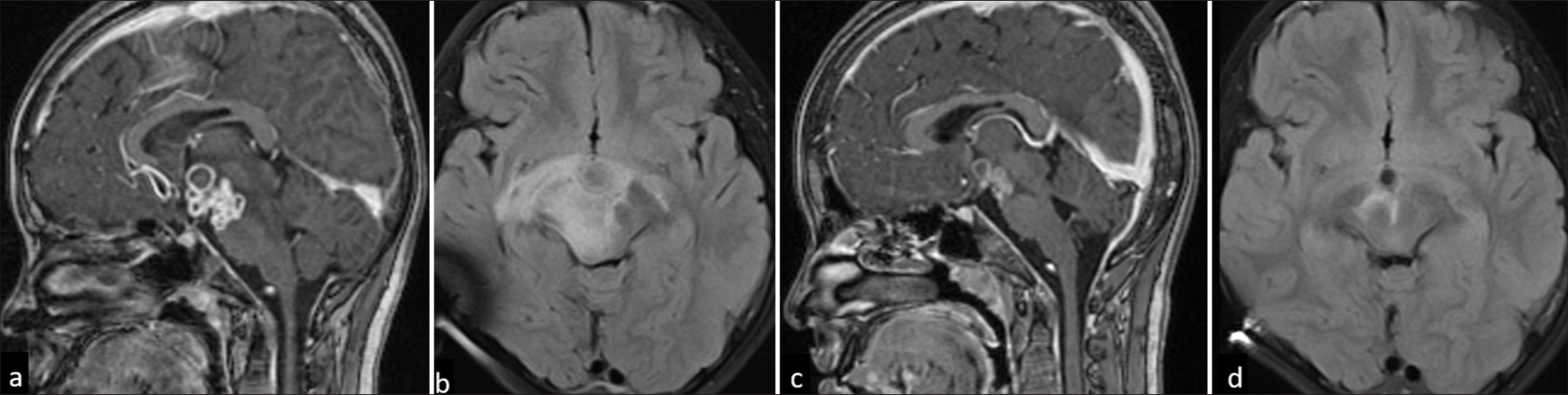 An 11-year-old female with optochiasmatic tuberculomas. (a) Sagittal T1-weighted post-contrast image shows multiple conglomerate ring-enhancing lesions in hypothalamus, inferior third ventricle, suprasellar and interpeduncular cisterns. (b) Fluid-attenuated inversion recovery (FLAIR) axial image showing edema along the bilateral optic tracts and mid-brain. A tuberculoma with partial FLAIR suppression is seen in the interpeduncular cistern. (c and d) Reduction in size and number of lesions and edema on 1-year 3-month follow-up.