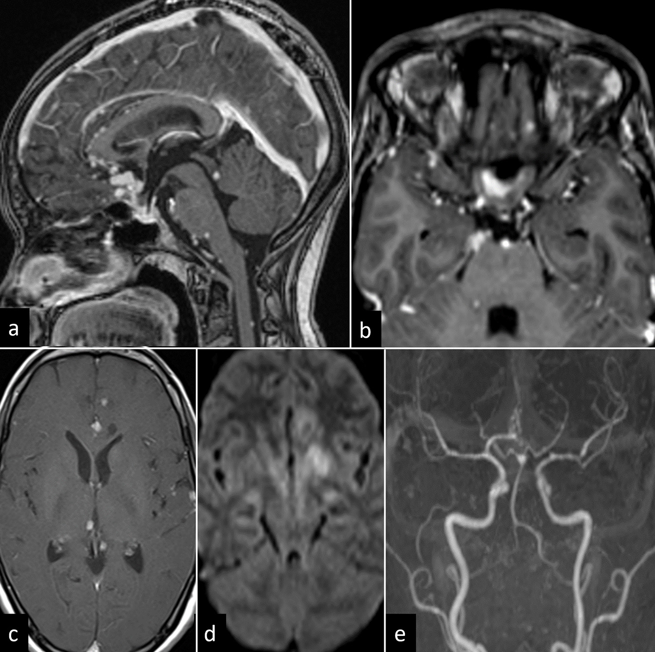 A 36-year-old female with tuberculosis meningitis and vasculitis. (a) Sagittal T1-weighted post-contrast image shows leptomeningeal thickening with conglomerate ring-enhancing lesions in anterior commissure, optic chiasm, and infundibulum. Few nodular enhancing lesions are noted in midbrain tectum at the level of inferior colliculus, pons, and posterior surface of cervical cord. (b and c) Axial T1-weighted post-contrast image shows thick exudates along optic chiasma and multiple ring-enhancing lesions in anterior interhemispheric fissure, bilateral cerebral hemispheres, and right thalamus. (d) Diffusion-weighted image shows acute infarct in the left basal ganglia. (e) Time-of-flight angiography shows luminal narrowing in bilateral middle cerebral, anterior cerebral, and posterior cerebral arteries (left more than right).
