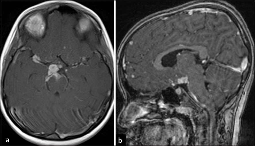 A 6-year-old female child with tuberculosis meningitis. (a) Axial T1-weighted post-contrast image shows thick basal exudates in bilateral Sylvian cisterns (right > left), suprasellar and interpeduncular cisterns. (b) Sagittal T1-weighted post-contrast image shows conglomerate ring-enhancing lesions (RELs) in supra-optic recess and hypothalamic regions. Few RELs are noted in the frontal lobe.
