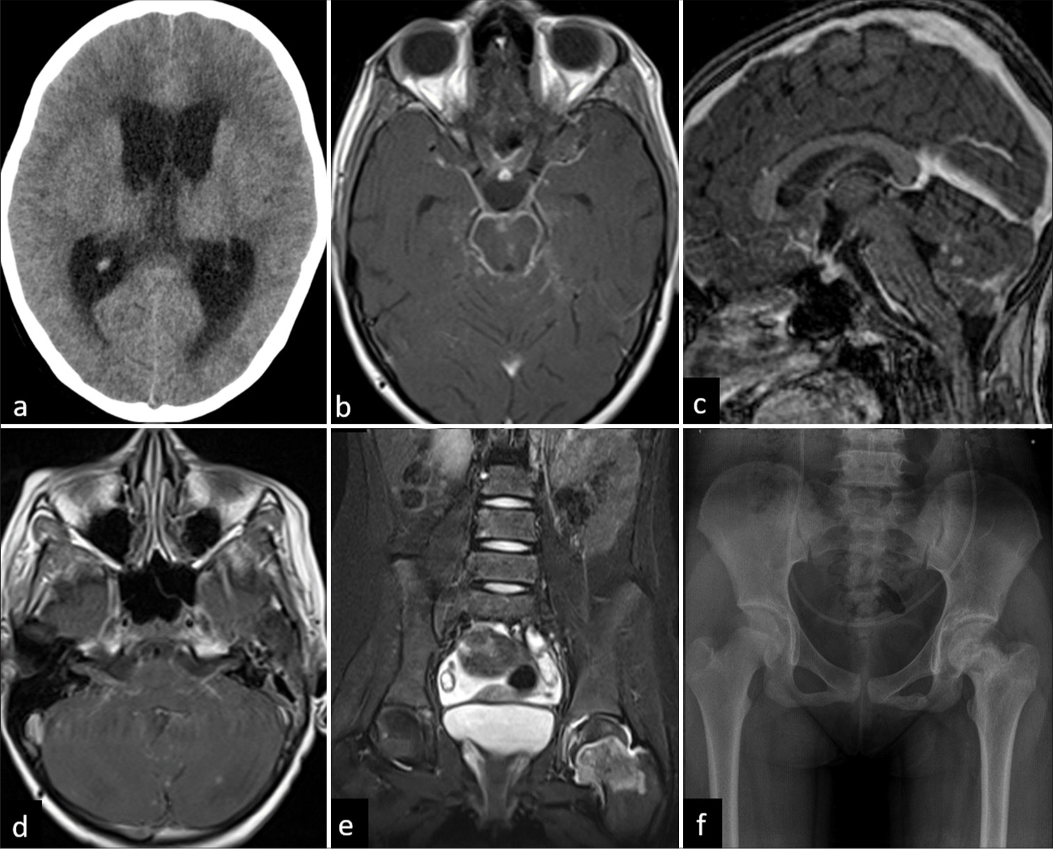 A 12-year-old female child with optochiasmatic arachnoiditis. (a) Axial unenhanced computed tomography showing hydrocephalus. (b) Axial T1-weighted post-contrast image shows leptomeningeal enhancement in basal cisterns and chiasmatic region. (c) Sagittal T1-weighted post-contrast image shows ring-enhancing lesions in bilateral cerebellar hemispheres. (d) Axial T1-weighted post-contrast image shows enhancement along cisternal portion of bilateral seventh and eighth nerve complex. The same patient had tuberculosis left hip joint. (e) Coronal T2-fat suppressed image of pelvis shows marrow edema in the left femoral neck with mild joint effusion. (f) X-ray pelvis on 1-year follow-up showing progression of the disease with sclerosis of subchondral region and neck of femur.