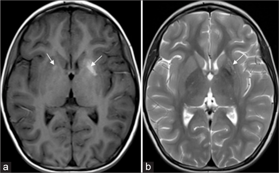 (a) T1-weighted axial image showing hyperintensity in bilateral basal ganglia, more on the left side (arrows). (b) Corresponding T2-weighted axial image showing heterogeneous mixed signal in the left basal ganglia.