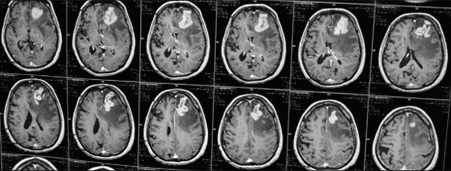 MRI Brain (T1 contrast) showing irregular contrast enhancing mass lesion in the left frontal lobe with mass effect.