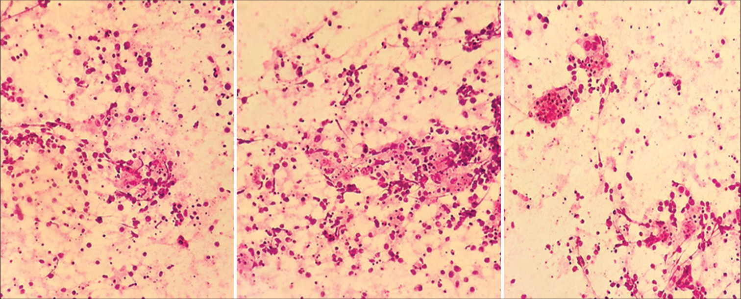 Squash smears predominantly showing histiocytes with emperipolesis, H&E, 40X. H&E: Hematoxylin and eosin.