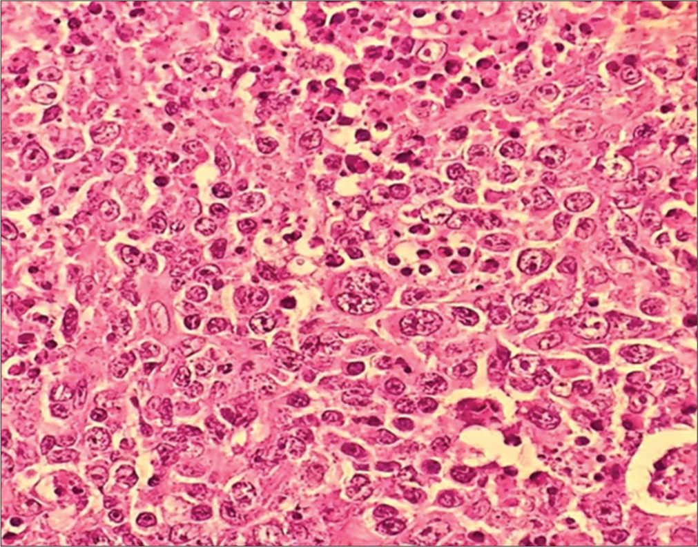 Histopathological images of Hodgkin’s lymphoma with Reed-Sternberg cells, H&E, 40X. H&E: Hematoxylin and eosin.