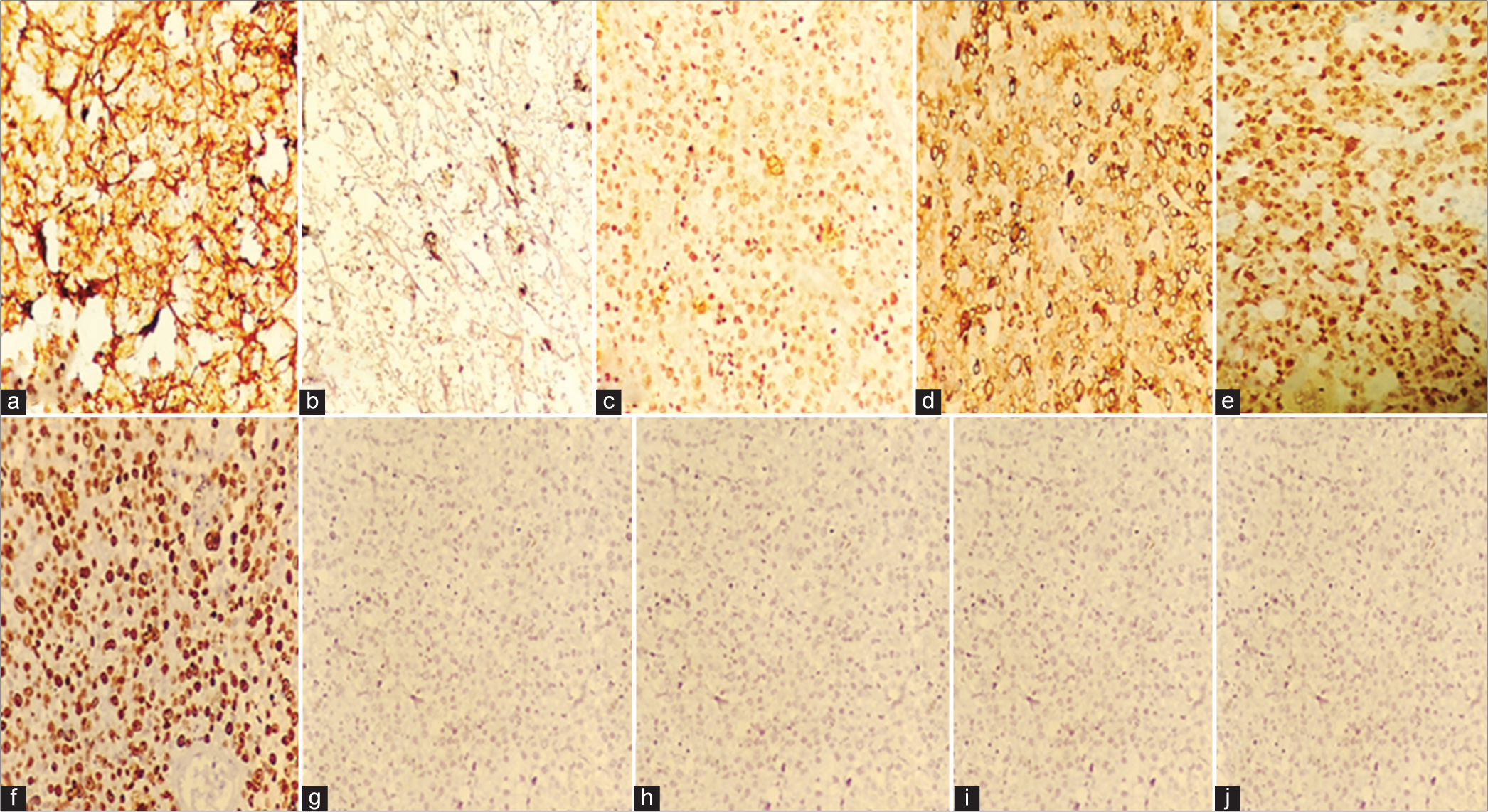 (a) CD45 - Positive in all the hematopoietic elements, (b) CD15 - Cytoplasmic and membranous positivity of large cells, (c) CD30-Cytoplasmic and membranous positivity of large cells, (d) CD79a- Membranous positivity of large cells, (e) PAX-5- Weak nuclear positivity of large cells, (f) Ki-67: 70%, (g) HMB – 45: Negative in the tumor cells, (h) GFAP: Negative in the tumor cells, (i) Pan CK: Negative in the tumor cells, (j) EBV: Negative in the tumor cells.