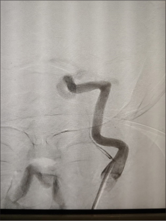 Early arterial injection of left internal carotid artery showing origin of ascending pharyngeal artery.