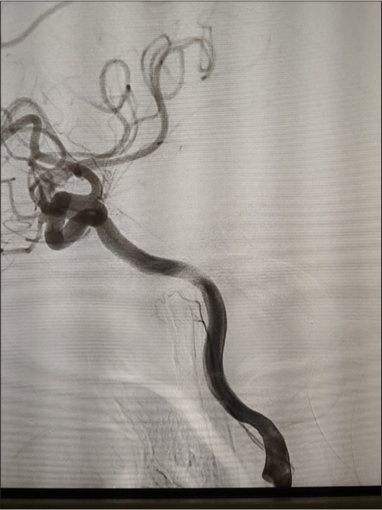 Left internal carotid artery injection showing filling of ascending pharyngeal artery which is originating from cervical internal carotid artery.