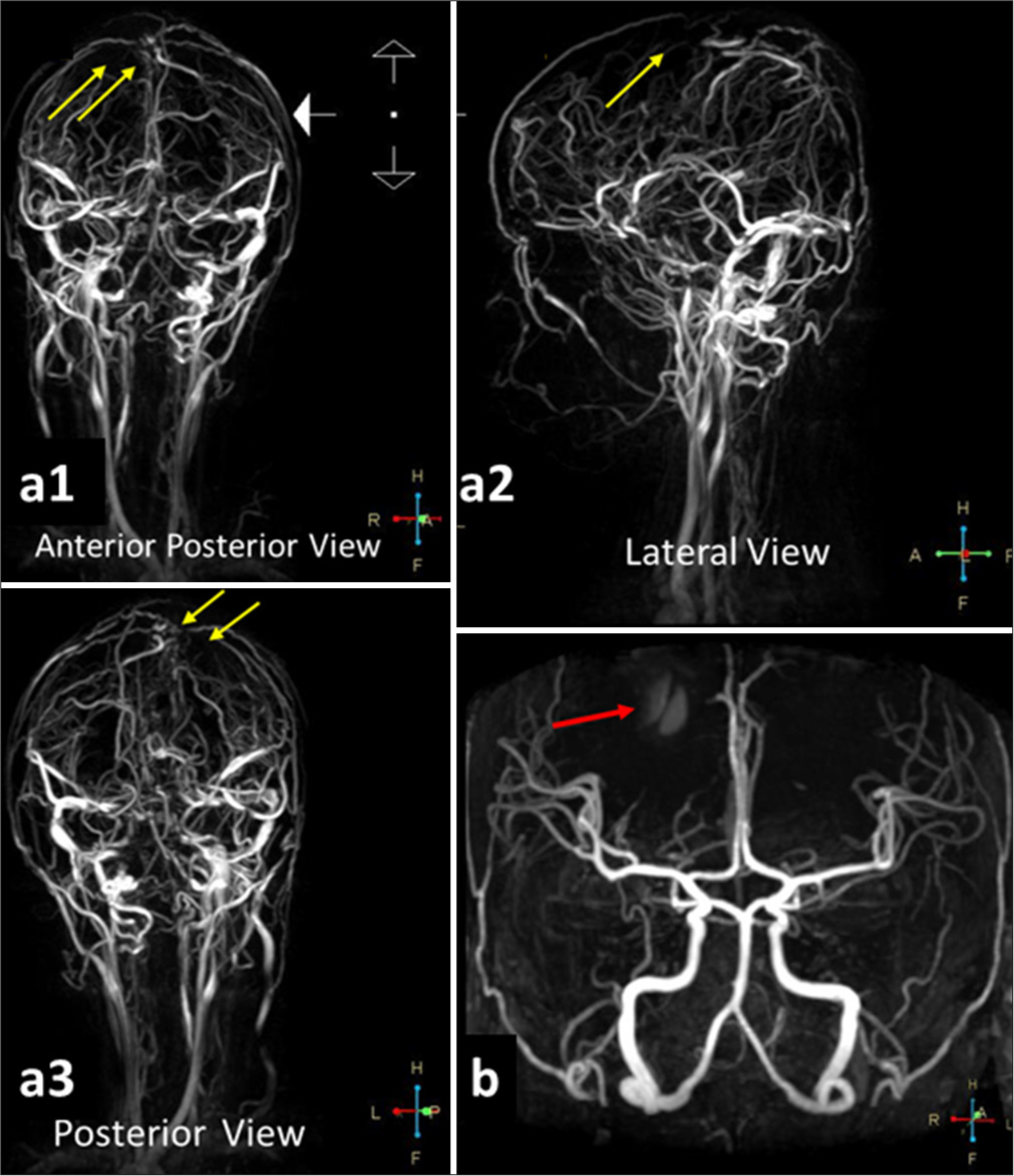 MRV and MRA brain sequences in a patient with CVST. (a1) The anterior-posterior view of the MRV demonstrates a segmental cutoff or occlusion in the superior sagittal sinus and cortical veins (yellow arrows), confirming the diagnosis of CVST; (a2) The lateral view of the MRV similarly shows a segmental cut-off or occlusion in the superior sagittal sinus and cortical veins (yellow arrow), further supporting the diagnosis of CVST; (a3) The posterior view of the MRV reveals a segmental cut-off or occlusion in the superior sagittal sinus and cortical veins (yellow arrows), confirming the presence of CVST; (b) The anterior cranial view of the MRA indicates contrast leakage (red arrow), confirming the presence of late subacute hemorrhage in the right frontal lobe accompanied by perifocal edema. This phenomenon is attributed to venous occlusion, which disrupts normal blood flow, leading to venous hypertension, edema, and ischemic changes in the affected cortical regions. MRI: Magnetic resonance imaging, CVST: Cerebral venous sinus thrombosis, MRA: Magnetic resonance angiography, MRV: Magnetic resonance venography.