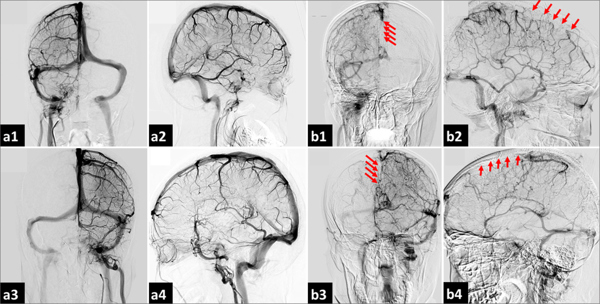 Cerebral digital subtraction angiography: Venous phase in a patient with CVST. (a1) Contrast injection from the right internal carotid artery (Rt-ICA) in the anterior-posterior view reveals a normal pattern of the cerebral venous sinus; (a2) The lateral view of contrast injection from the Rt-ICA also displays a normal pattern of the cerebral venous sinus; (a3) Contrast injection from the left internal carotid artery (LtICA) in the anterior-posterior view shows a normal pattern of the cerebral venous sinus; (a4) The lateral view of contrast injection from the Lt-ICA similarly demonstrates a normal pattern of the cerebral venous sinus; (b1) Contrast injection from the Rt-ICA in the anterior-posterior view indicates reduced flow to the superior sagittal sinus and bilateral cortical veins, particularly on the right side, raising the suspicion of thrombosis in both the superior sagittal sinus and cortical veins (red arrows); (b2) The lateral view of contrast injection from the Rt-ICA corroborates the finding of reduced flow to the superior sagittal sinus and bilateral cortical veins, especially on the right side, suggesting possible thrombosis (red arrows); (b3) Contrast injection from the Lt-ICA in the anterior-posterior view reveals diminished flow to the superior sagittal sinus and bilateral cortical veins, predominantly on the right side, further indicating potential thrombosis (red arrows); and (b4) The lateral view of contrast injection from the Lt-ICA also shows reduced flow to the superior sagittal sinus and bilateral cortical veins, particularly on the right side, reinforcing the possibility of thrombosis in these regions (red arrows). CVST: Cerebral venous sinus thrombosis.