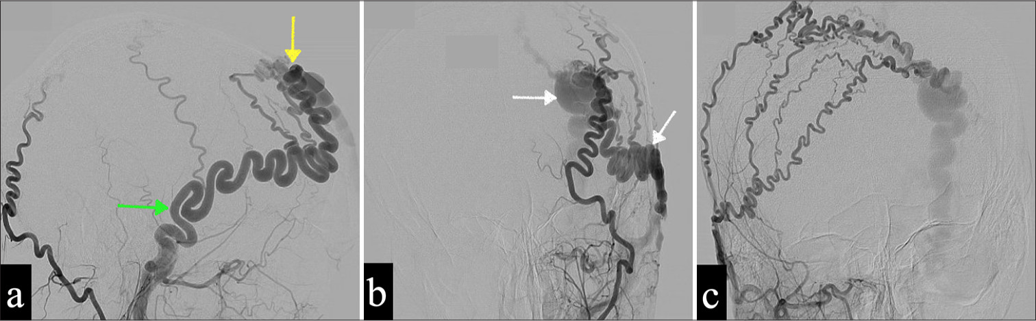 (a and b) Pre-operative cerebral angiography of the selective left external carotid artery in the frontal and lateral planes shows predominant feeders from the left superficial temporal artery (STA) (green arrow), a fistulous point (yellow arrow), and dilated draining veins (white arrows). (c) There are supplementary feeding arteries contributed by the contralateral STA, which fill the draining veins.