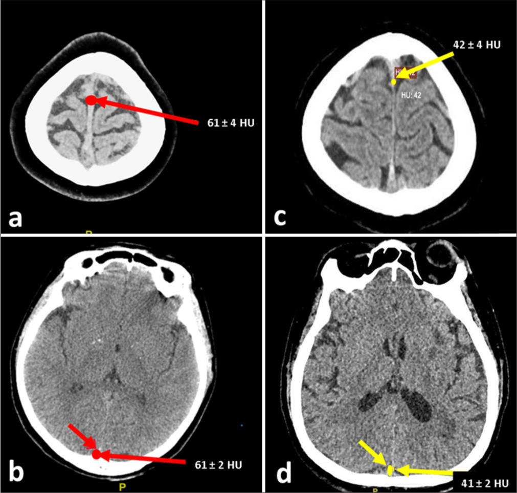 Non-contrast computed tomography imaging in cerebral venous sinus thrombosis (CVST) patients and control subjects. (a) Hyperdense thrombosis in the superior sagittal sinus (SSS) (red arrow), measuring 61±4 HU. (b) Hyperdense thrombosis in the inferior sagittal sinus (ISS) (red arrow), measuring 61±2 HU. The hyperdensity indicates acute thrombus, characteristic of CVST. (c) Measurement of normal SSS density (yellow arrow) at 42±4 HU in a control subject. (d) Measurement of normal ISS density (yellow arrow) at 41±2 HU in a control subject. HU: Hounsfield units.