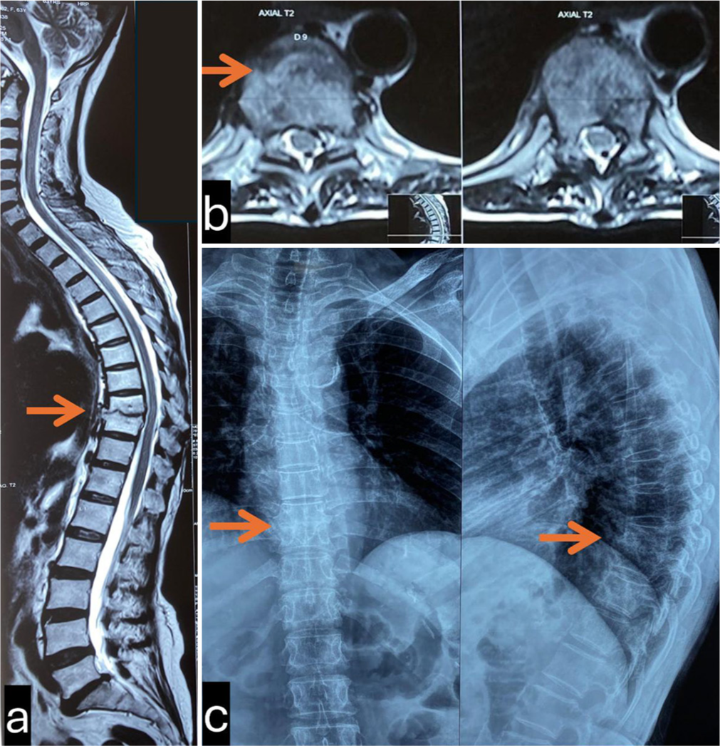 Post-treatment radiological investigations, (a and b) MRI showing resolution of disease with healing at D9-D10 disc space, (c) X-ray showing vertebral body integrity being maintained.