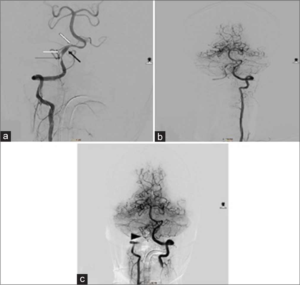 (a) Digital subtraction angiography of right VA injection shows pseudoaneurysm (thick black arrow) as dilatation of right vertebral artery at V4 segment, stenosis (thin black arrow) of the same segment, and duplication of origin of PICA (white arrows). (b) Left VA injection demonstrates adequate blood flow to the right PICA from the contralateral (left) VA. (c) Simultaneous right and left VA injection shows occlusion of right VA with coil mass (arrowhead) with preservation of blood flow to right PICA from left VA.