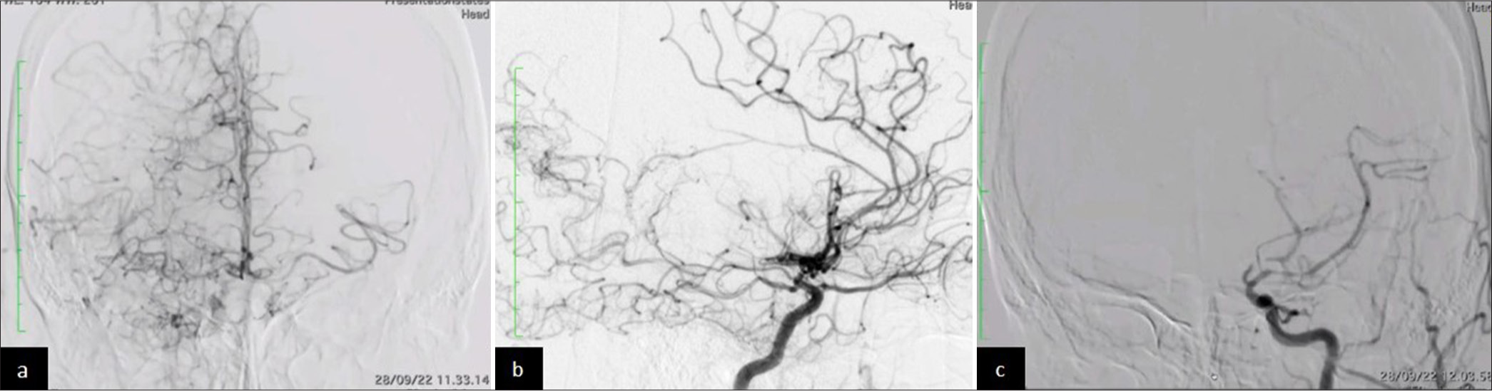 (a) Right internal carotid artery (ICA) in digital subtraction angiography (DSA) (anteroposterior view): “Puff of smoke” collaterals in the right middle cerebral artery (MCA) lenticulostriate arteries and pericallosal region. (b) Right ICA DSA (lateral view): Prominent collateral vessels reconstituting the right MCA territory. (c) Left ICA DSA (lateral view): Complete anterior cerebral artery occlusion and severe posterior cerebral artery stenosis.