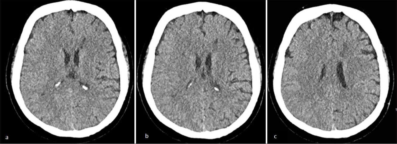 (a-b) Axial non-contrast head computed tomography scan reveals a hypodense region in the left anterior cerebral artery and middle cerebral artery border (watershed) zone at the level of basal ganglia. (c) The non-contrast head computed tomography scan reveals hypodense region at the corona radiata level..
