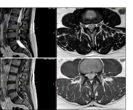 (a) Sagittal and axial lumbar MRI images. T2 non-contrasted sequence showing low T2 signal-intensity intradural/extramedullary lesion extending from the lower aspect of L2 to L4–L5 disc level. (b) Sagittal and axial T1 contrasted image showing diffuse homogenous enhancement of the lesion. L: Lesion, T1W: T1-weighted MRI image without contrast, T2W: T2-weighted MRI image without contrast, TSE: Turbo spin echo, MDC: Mezzo di contrasto (contrast agent), AX: Axial, P: Posterior, R: Right, L: Left.