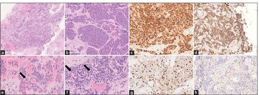 Photomicrographs of the resected specimen. (a-d) Hematoxylin and eosin stain shows a dense proliferation of small round cells with scant to absent cytoplasm, high nucleus/cytoplasm ratio with fine strippled chromatin, (c, arrow) sparse mitoses and (d, arrow) small nucleoli. (e) Immunohistochemical reactions demonstrating diffuse nuclear positivity for NKX2.2, (f) membranous positivity for CD99 and (g) a proliferation index of 40%. (h) Staining for cytokeratins AE1/AE3 was negative.