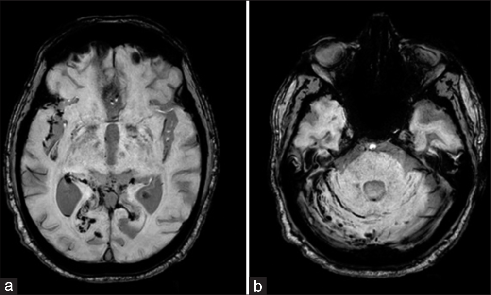 Axial magnetic resonance imaging of the brain on susceptibility-weighted imaging shows (a) hemorrhage within the right Sylvian fissure, bilateral occipital lobes, the occipital horn of the right lateral ventricle, and (b) along the right cerebellar folia.