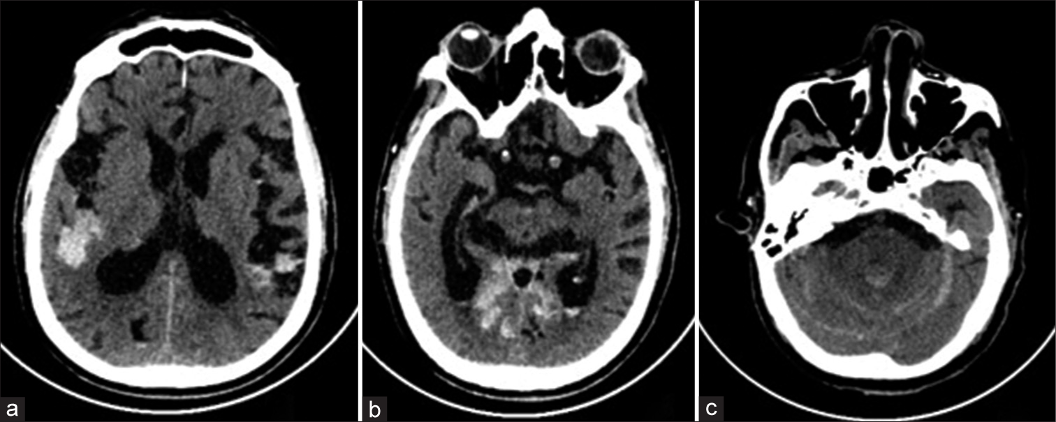 Axial images of plain computed tomogram scan of the brain show subarachnoid hemorrhage in (a) bilateral Sylvian fissures and (c) cerebellar hemispheres. (b) Intraventricular hemorrhage in bilateral occipital horns and within the 4th ventricle.