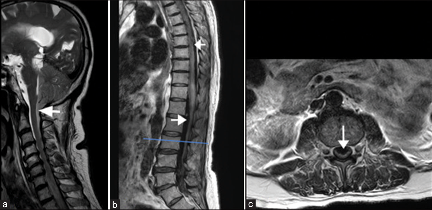 T2-weighted sagittal image of the (a) cervical spine, (b) thoracolumbar spine, and (c) axial section of the lumbar spine: Subarachnoid hemorrhage (SAH) extending into the cervical spinal cord as shown by the arrow. SAH is also noted as hypointense signals anteriorly and posteriorly in thoracic and lumbar thecal sac indicated by arrows in (b). Axial T2WI (c) through the lower lumbar spine shows subarachnoid hematoma compressing the cauda equina nerve roots in (c).