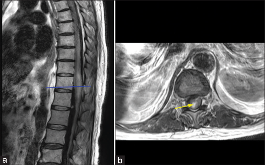 T2-weighted (a) sagittal and (b) axial images at the level of the lower thoracic spinal cord show expansion of the spinal cord with intramedullary hemorrhage, as evidenced by (b) hyperintense signal shown by the arrow.