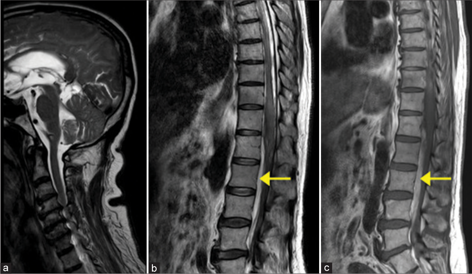 T2-weighted sagittal images of the (a) cervical, (b) thoracolumbar spines, and (c) T1 weighted sagittal image of the thoracolumbar spine. (a) Resolution of the subarachnoid hemorrhage in the cervical spine. (b,c) Anterior residual subacute hematoma displacing the cauda equina nerve roots posteriorly is noted in the lumbar levels, appearing hyperintense on (b) T2-weighted images and (c) T1-weighted images, as shown by the arrows in (b) and (c).