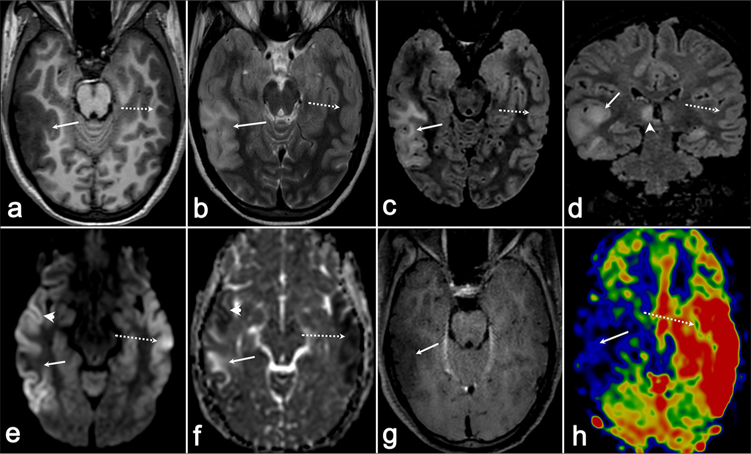 (a) Axial T1-weighted imaging (T1-WI) demonstrates a hypointense area in the right temporo-occipital region (arrow), which appears (b) hyperintense on axial T2-weighted imaging (T2-WI) (arrow) and (c and d) fluid-attenuated inversion recovery (FLAIR) sequences (arrows). (e) Diffusion-weighted imaging (arrowhead) shows diffusion restriction in the anterior and posterior aspects of this abnormality, which corresponds to (f) hypointensity on the apparent diffusion coefficient map (arrowhead), whereas (e and f) the central portion exhibits facilitated diffusion (arrows). (g) No contrast enhancement is observed on post-gadolinium images, and (h) the arterial spin labeling (ASL) perfusion map reveals reduced perfusion in this region (arrow). (e and f) In addition, there is another area of diffusion restriction in the left temporal region (dotted arrow), which shows (h) increased perfusion on ASL (dotted arrow) and (ad) appears isointense on T1-WI and T2-WI/FLAIR sequences (dotted arrow).